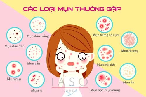 3 cấp độ mụn tắc nghẽn