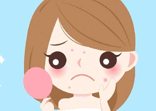 4 yếu tố hình thành mụn