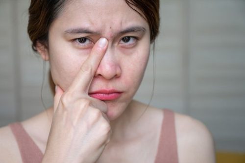 MỤN BIỂU TÌNH Ồ ẠT KIẾP NẠN NÀY GIẢI SAO