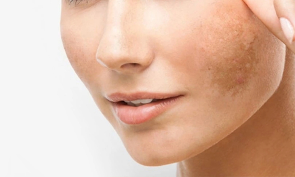 CÁCH TRỊ NÁM GÒ MÁ TẠI NHÀ HIỆU QUẢ BẠN ĐÃ BIẾT?