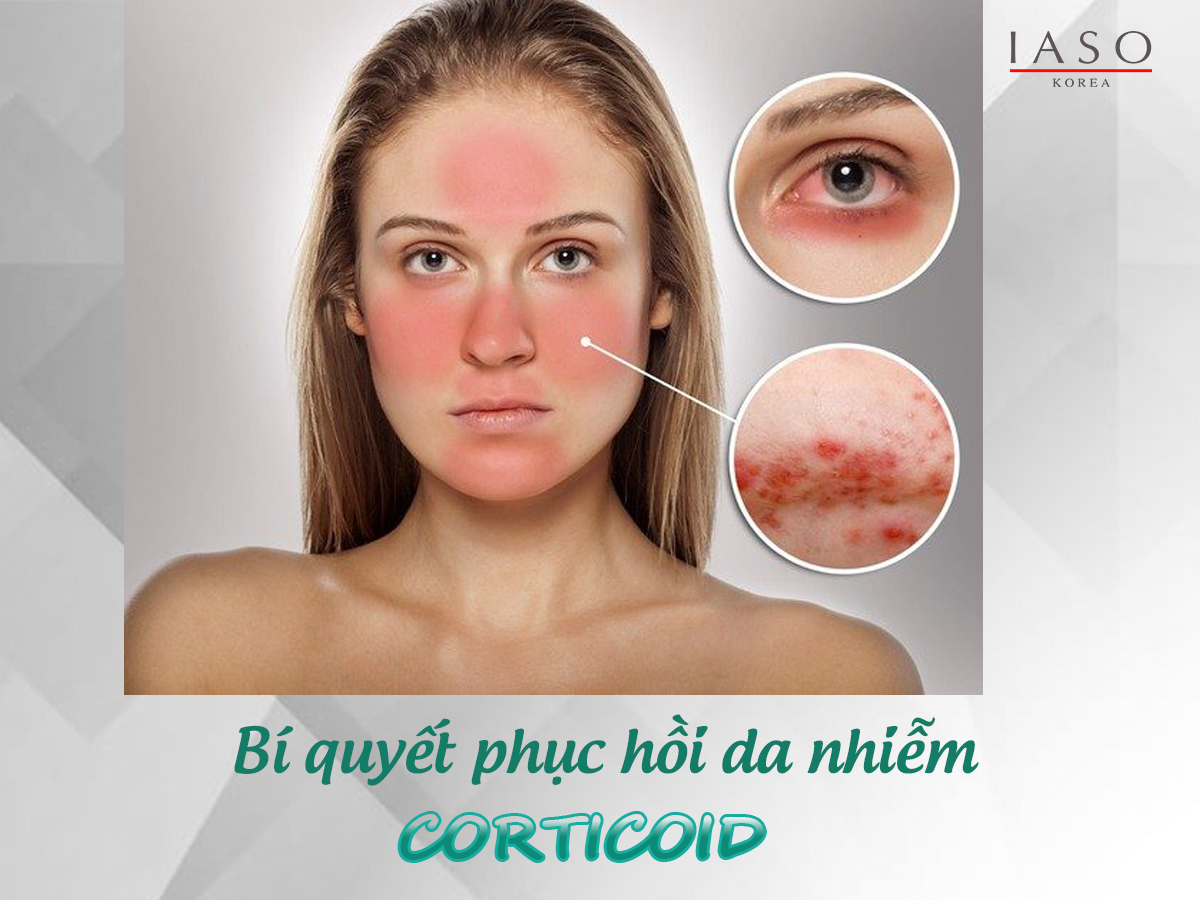 BÍ QUYẾT PHỤC HỒI DA NHIỄM CORTICOID